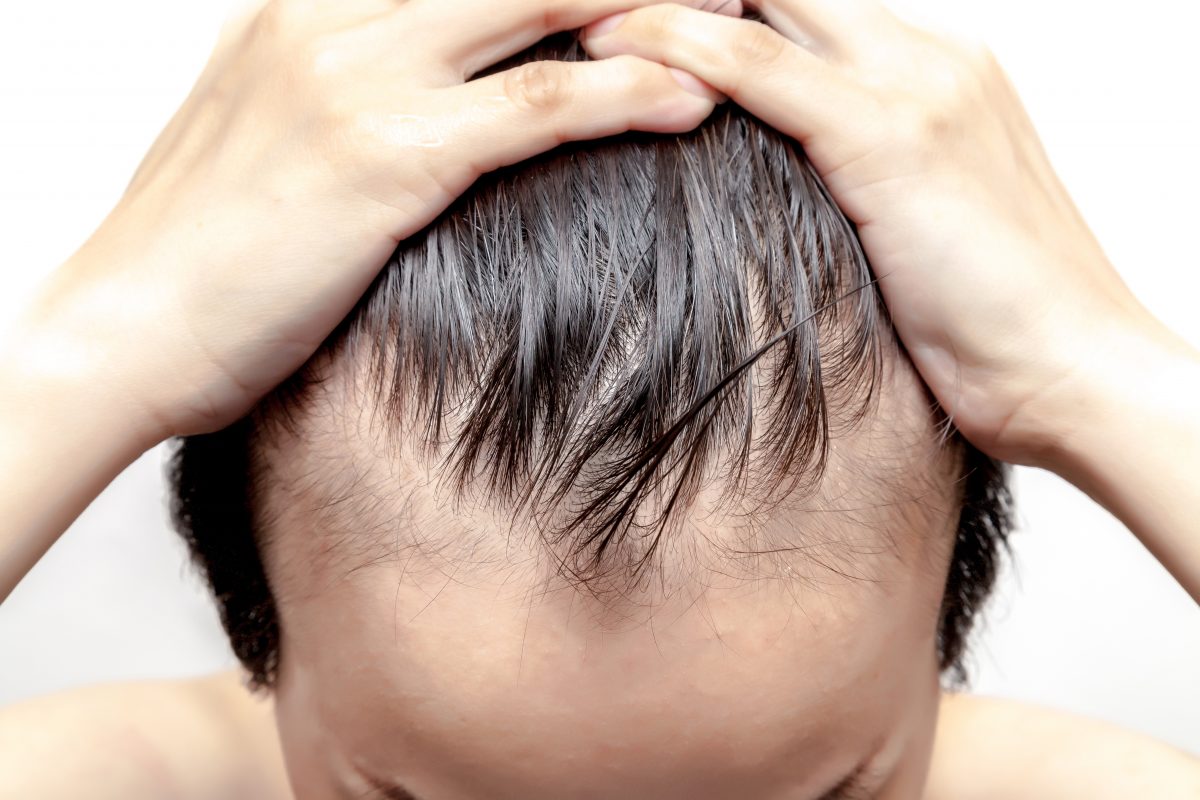 Lustrous hair superfoods prevent balding and hair loss